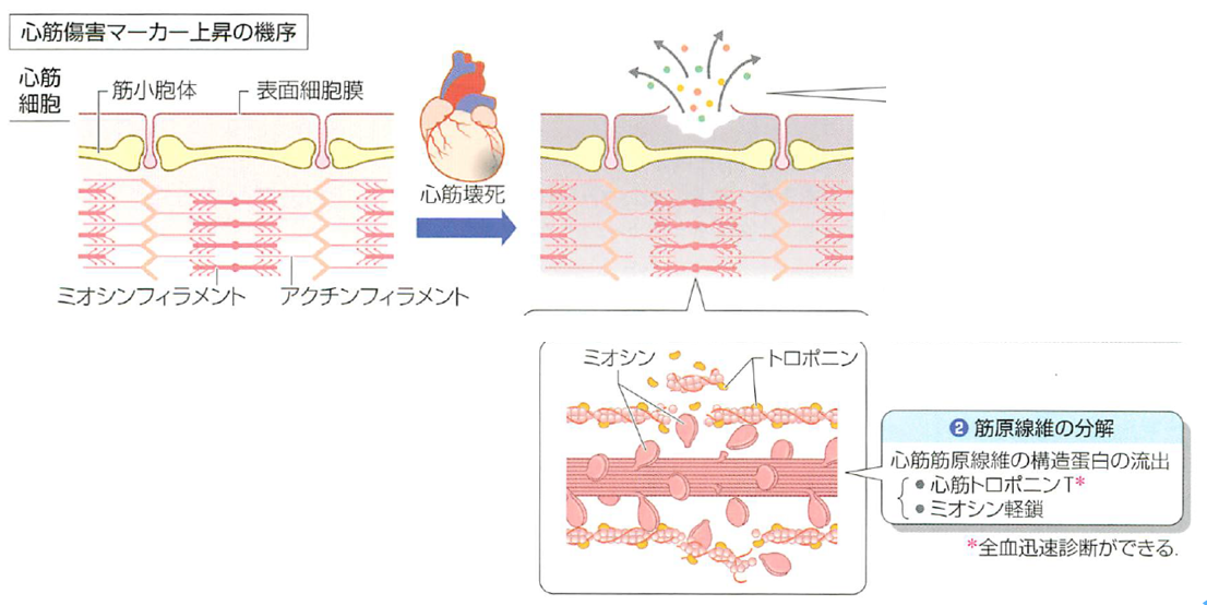 【循環器総論11】 BNPとトロポニン 心臓血管外科がゆるく始めたブログ