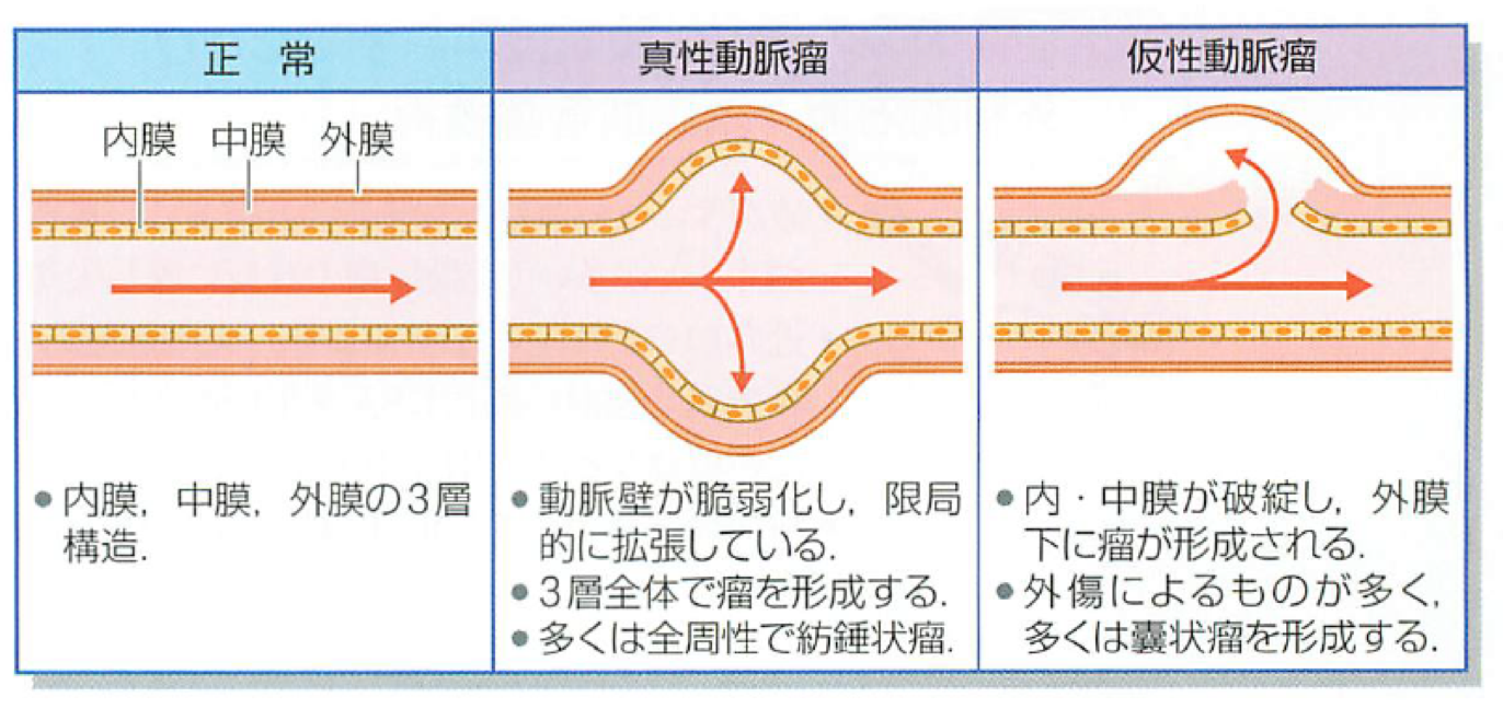 【循環器各論-5】大動脈瘤とは | 心臓血管外科 ️美容外科